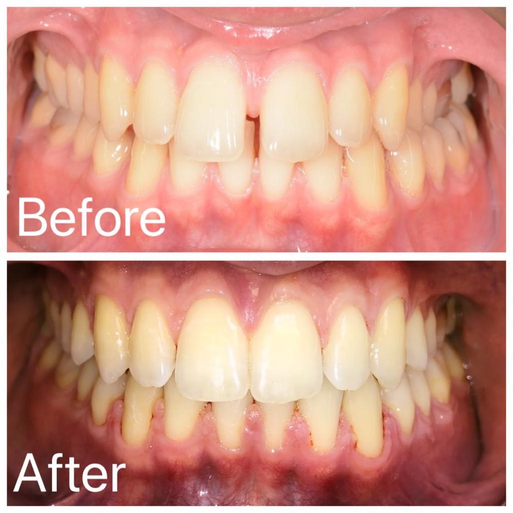 exhaust fur trade Aparat dentar – Ortodonție - Dental Zen Estetic
