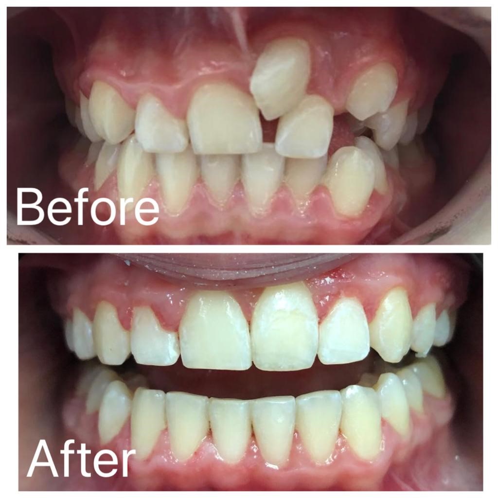 silent tear down after school before-and-after-3 - Dental Zen Estetic