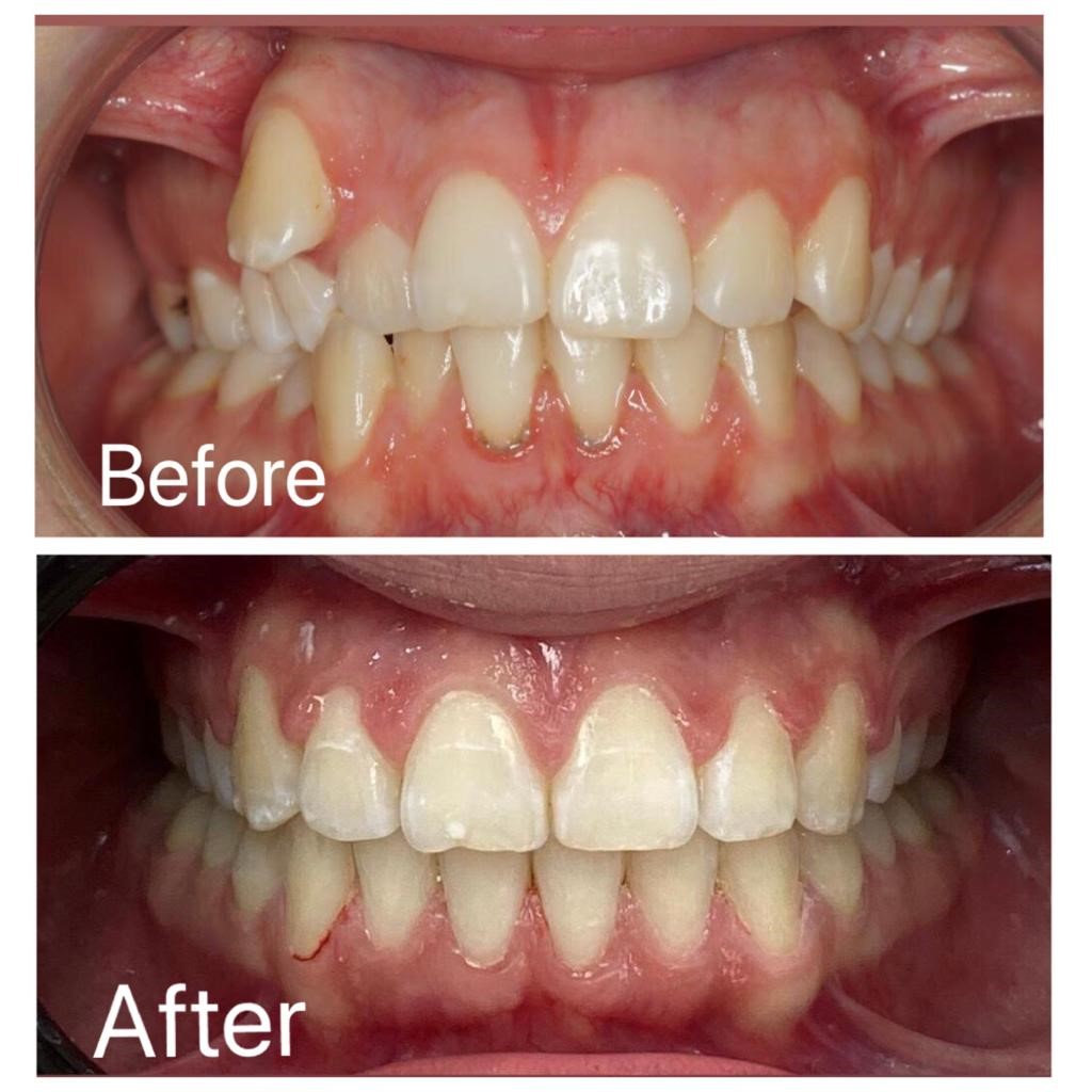 feel minor Nationwide Aparat dentar – Ortodonție - Dental Zen Estetic